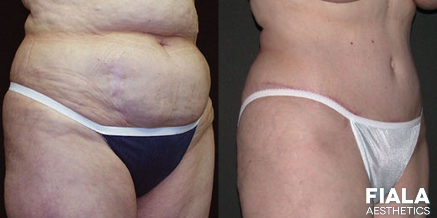 Tummy Tuck - Case 9089
