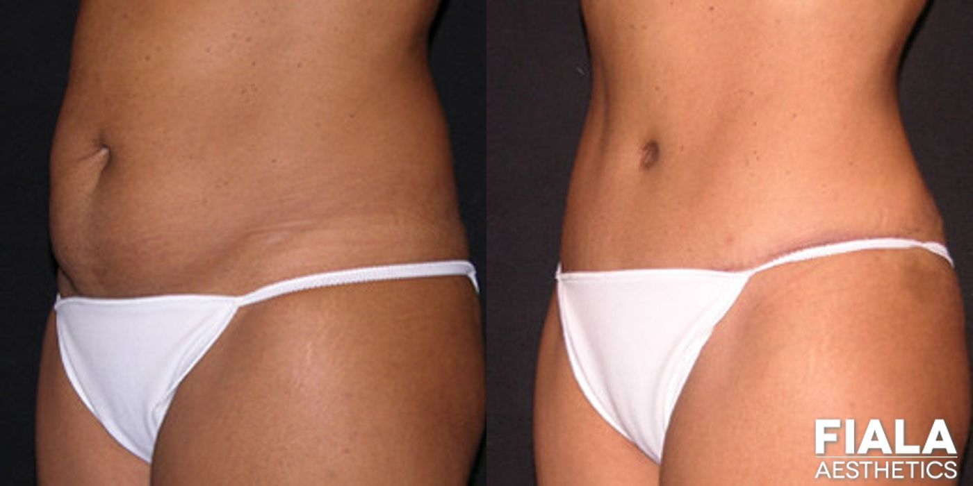 Tummy Tuck - Thumbnail 2