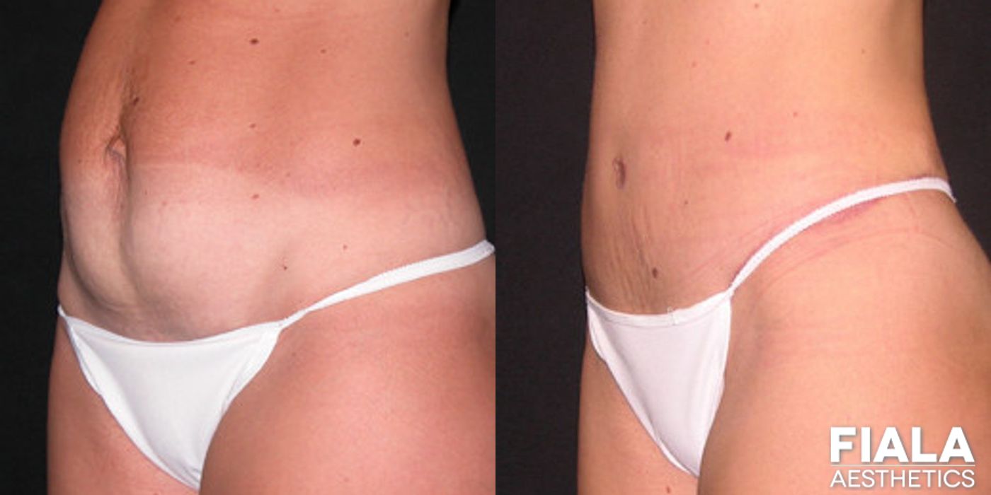 Tummy Tuck - Thumbnail 2