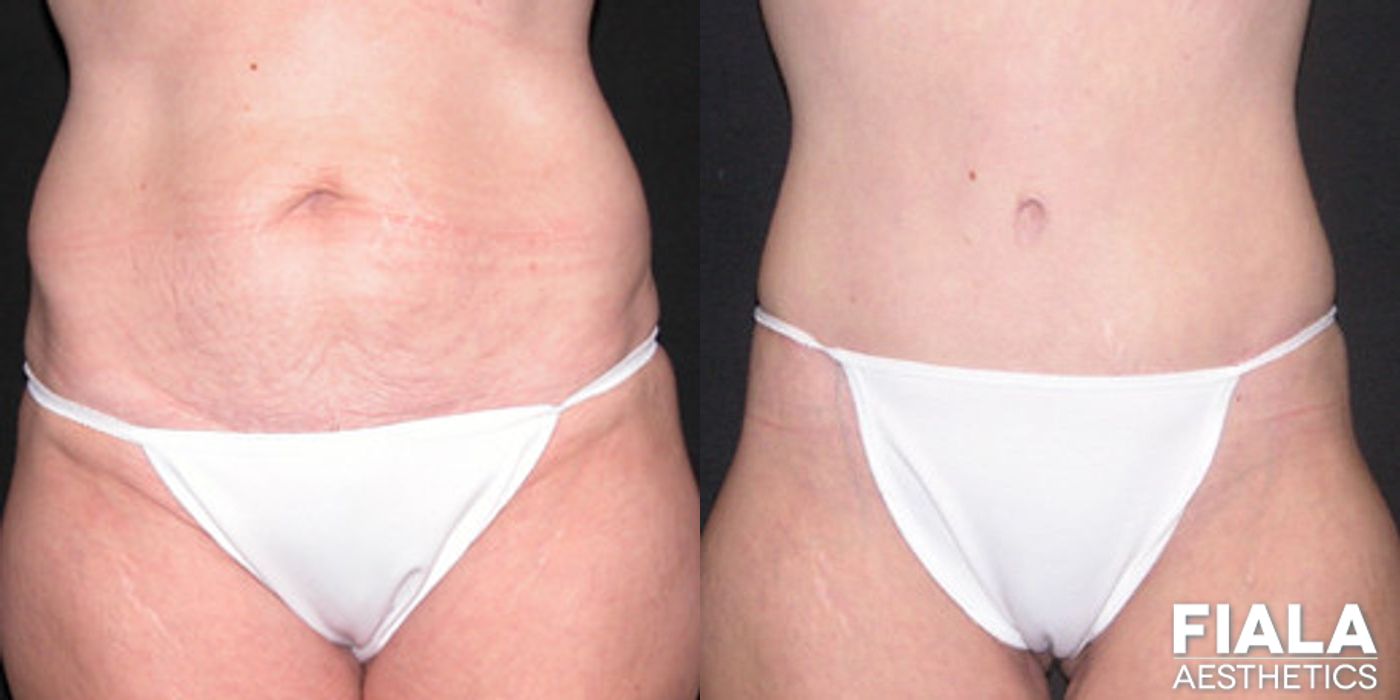 Tummy Tuck - Case 9081