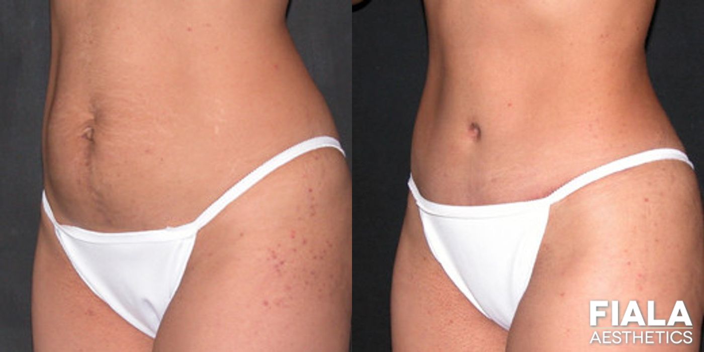Before and after Tummy Tuck case 13830 - Angle 2