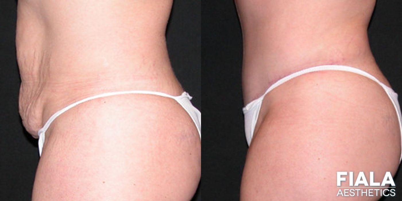 Before and after Tummy Tuck case 13835 - Angle 2