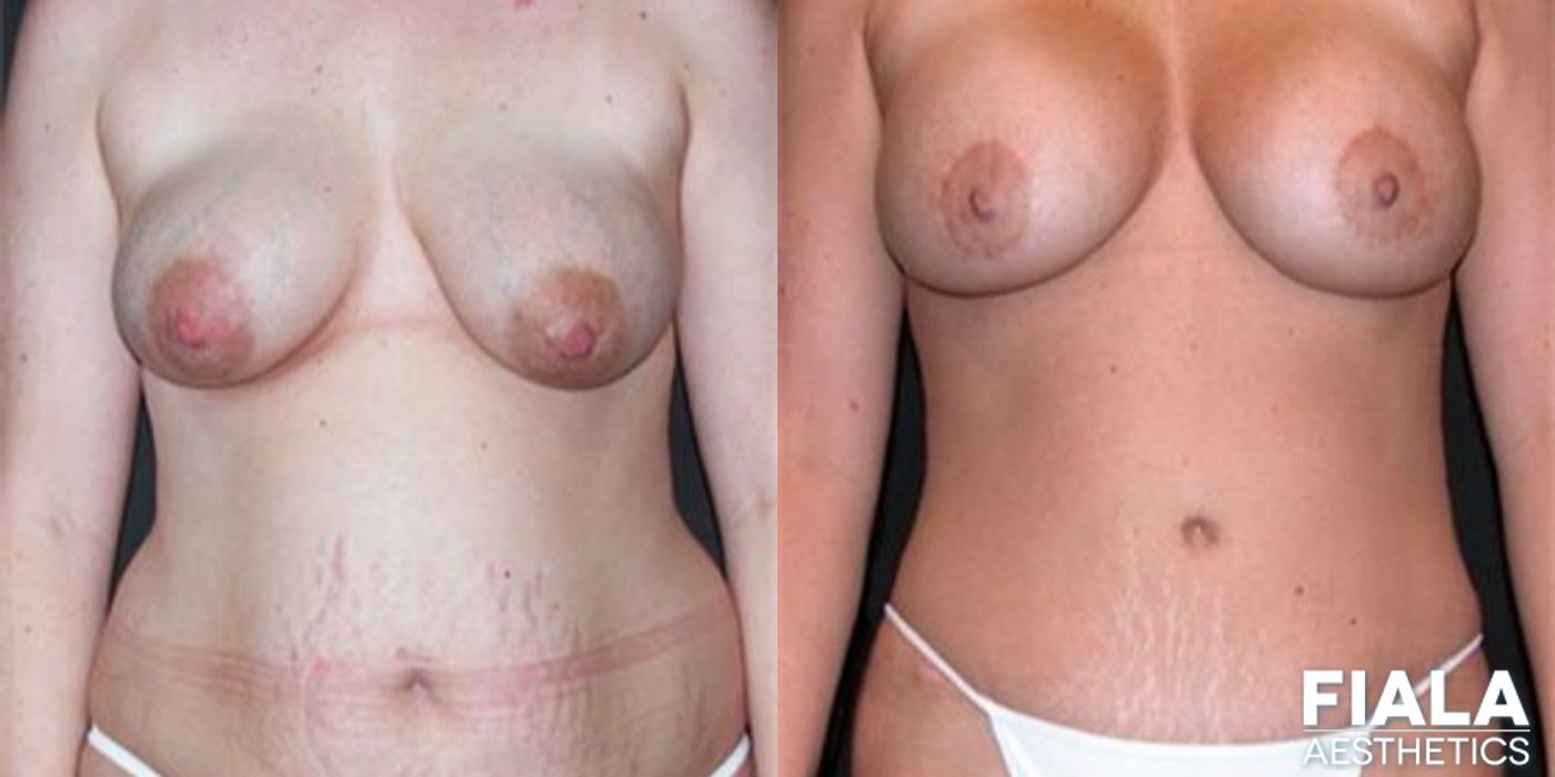 Breast Lift - Case 9181