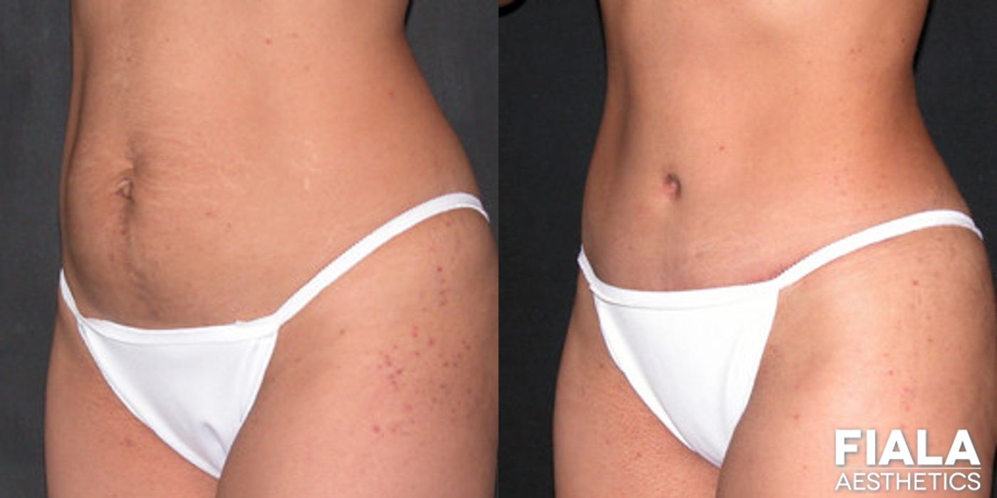 Tummy Tuck - Thumbnail 2