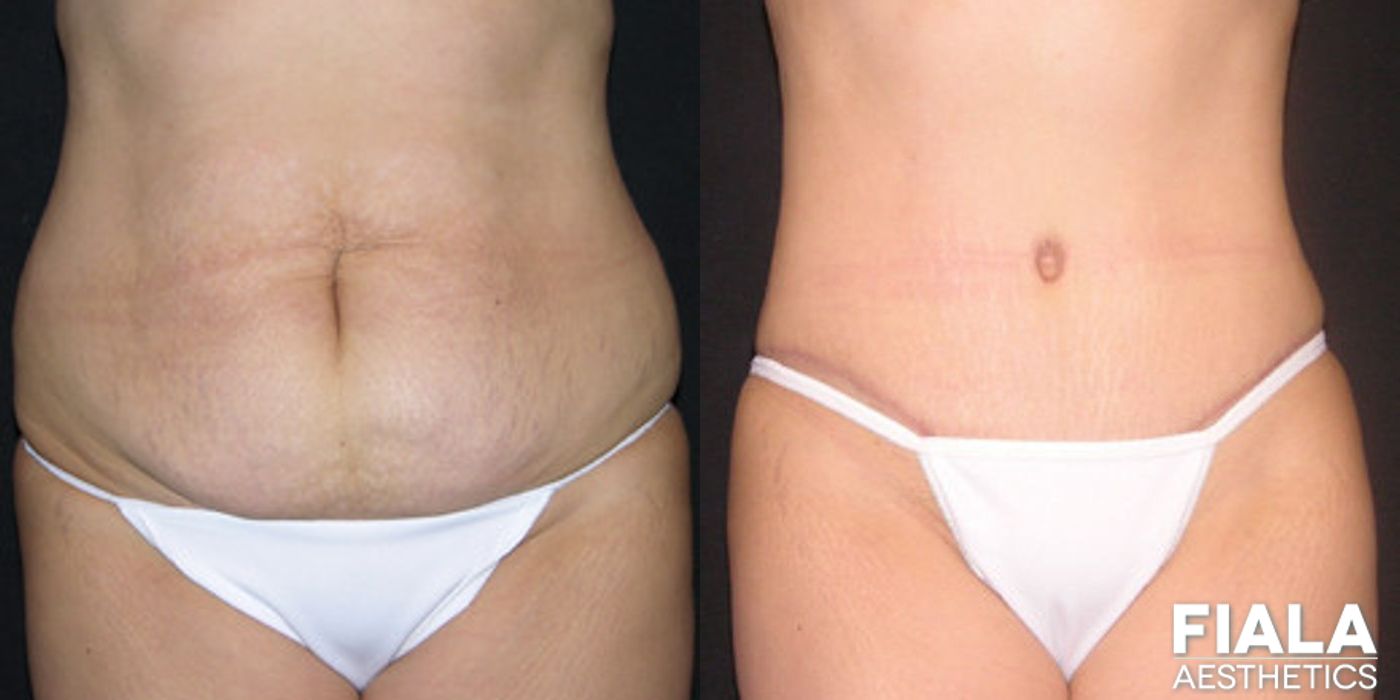 Tummy Tuck - Thumbnail 2