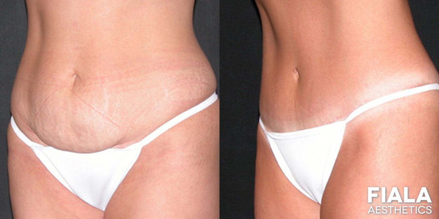 Before and after Tummy Tuck case 13838