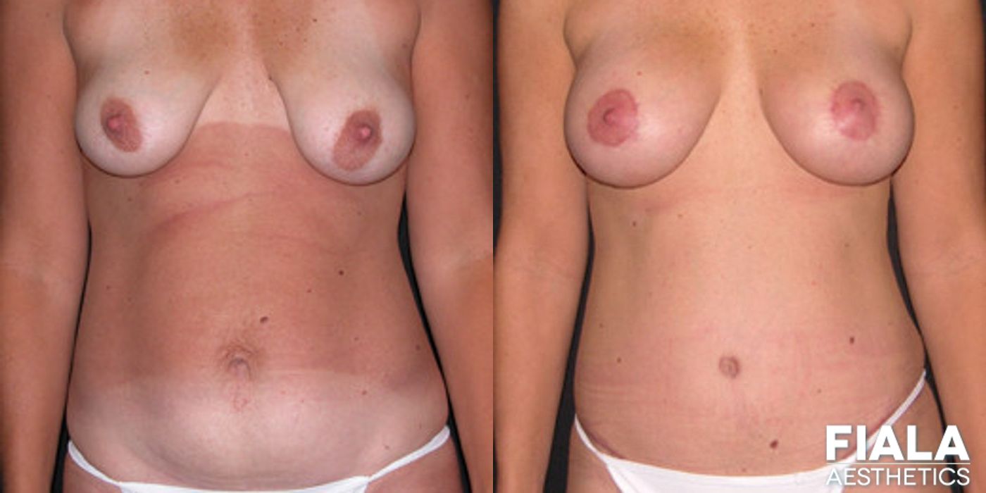 Breast Lift - Case 9180
