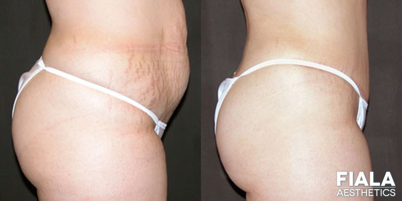 Before and after Tummy Tuck case 13842 - Angle 2