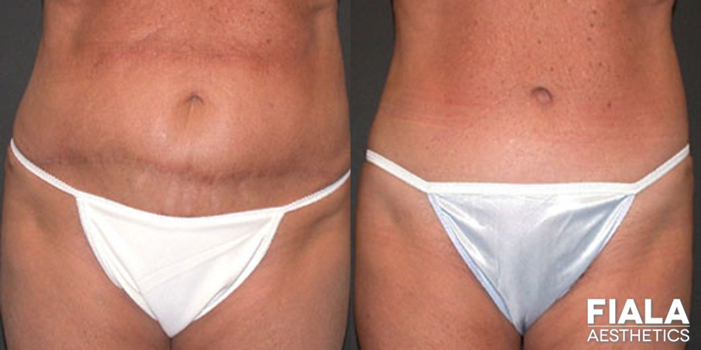 Before and after Tummy Tuck case 13822