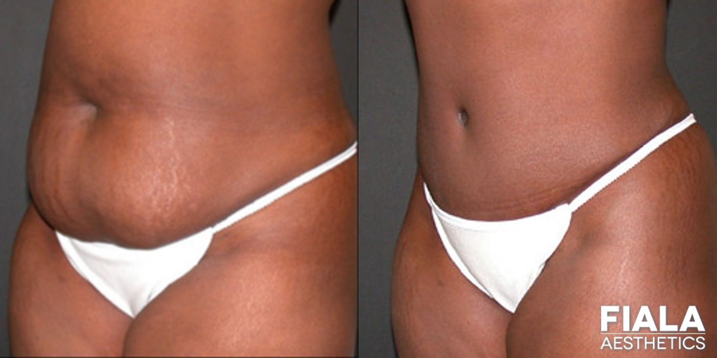 Before and after Tummy Tuck case 13813 - Angle 2