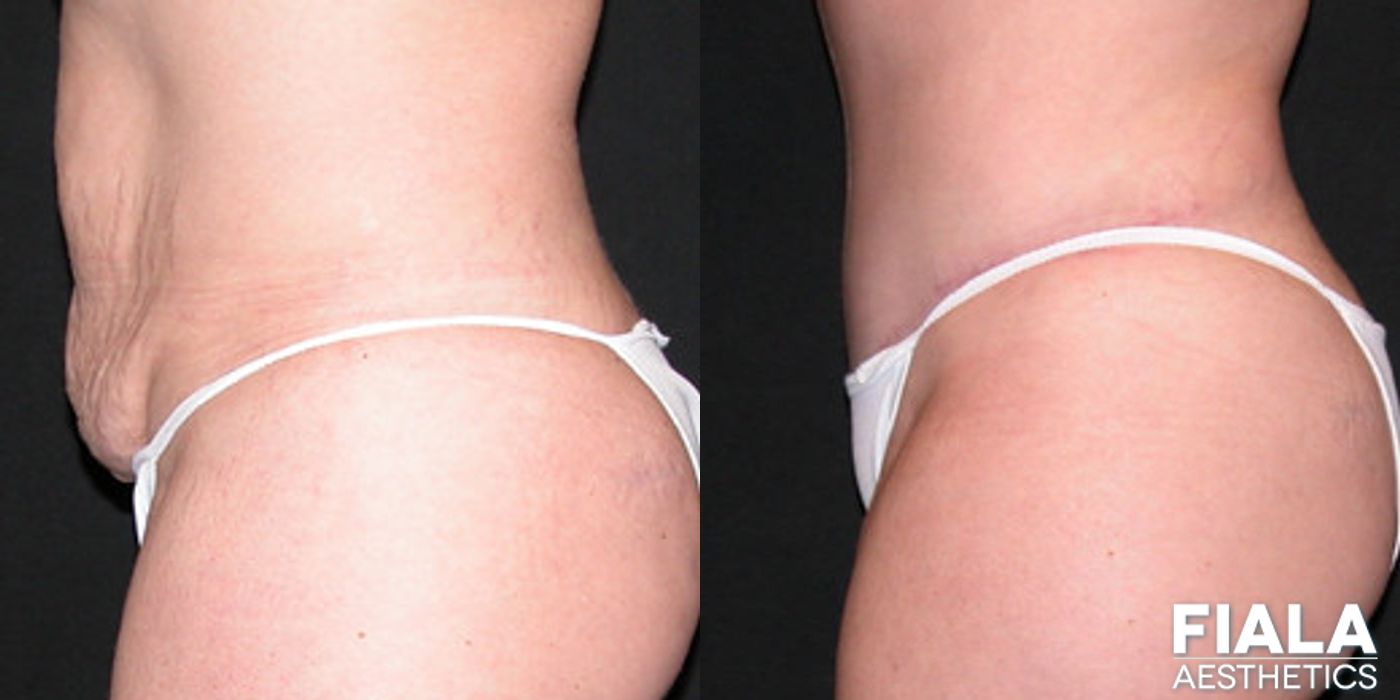 Tummy Tuck - Thumbnail 2