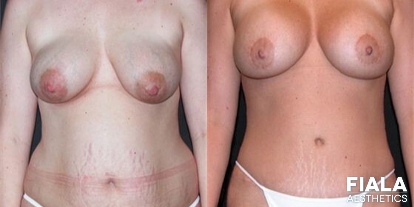Before and after Tummy Tuck case 13841