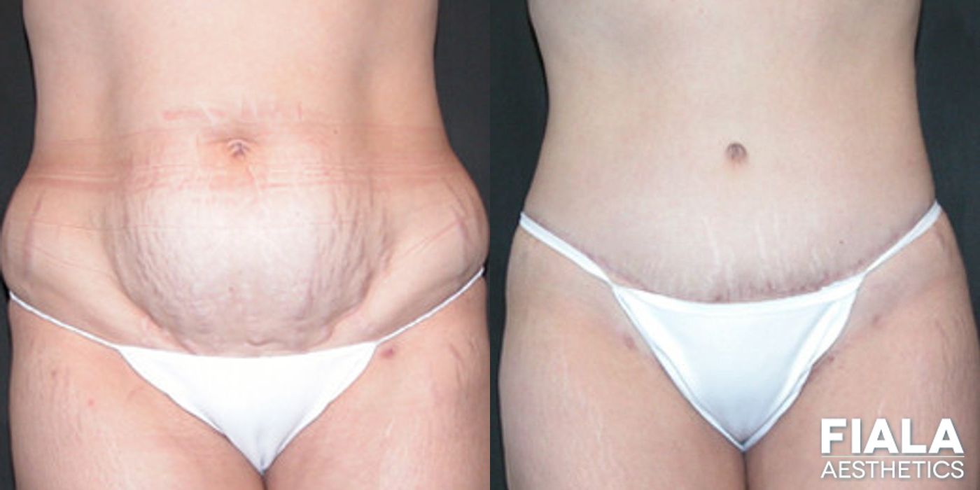 Before and after Tummy Tuck case 13827