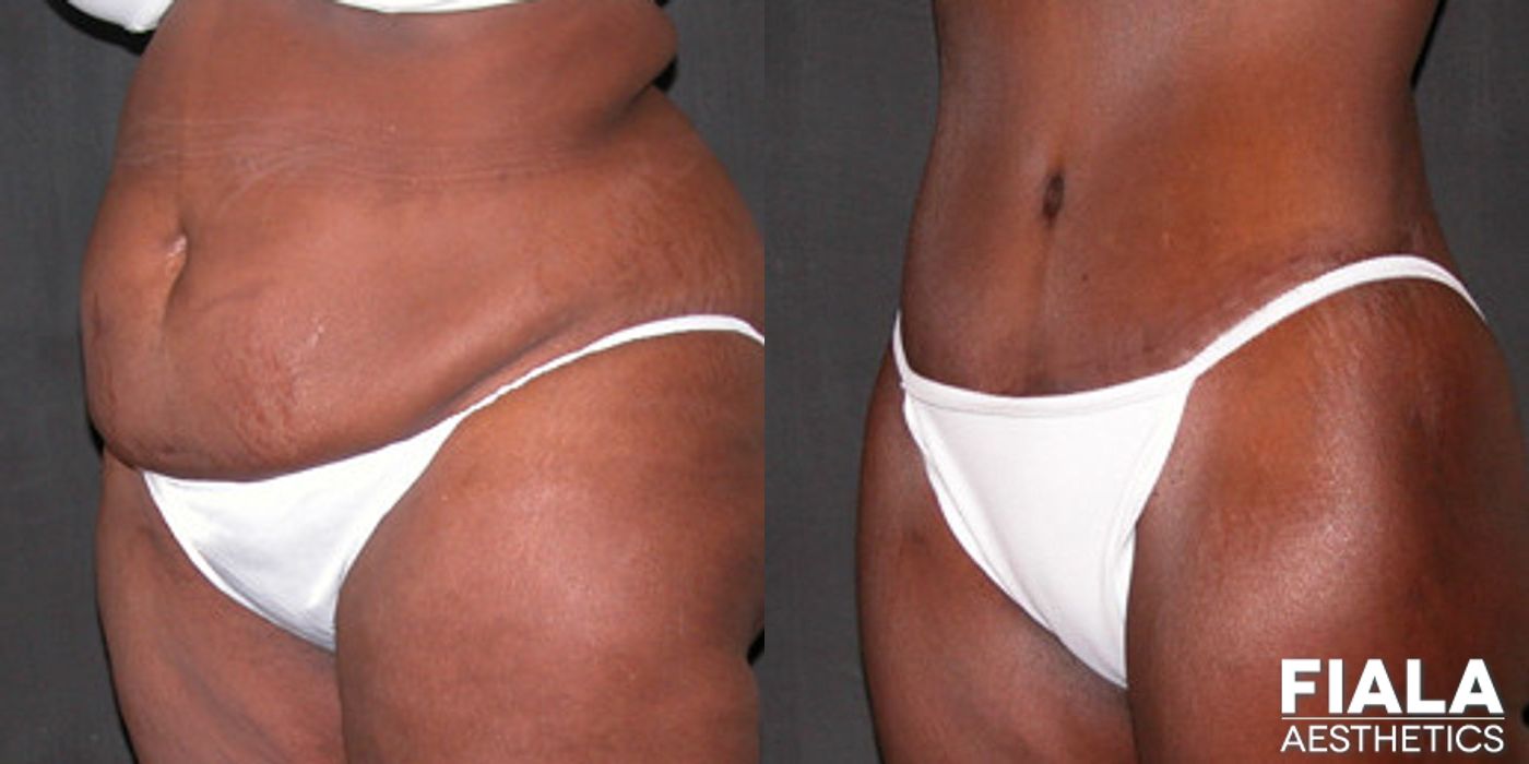 Tummy Tuck - Thumbnail 2