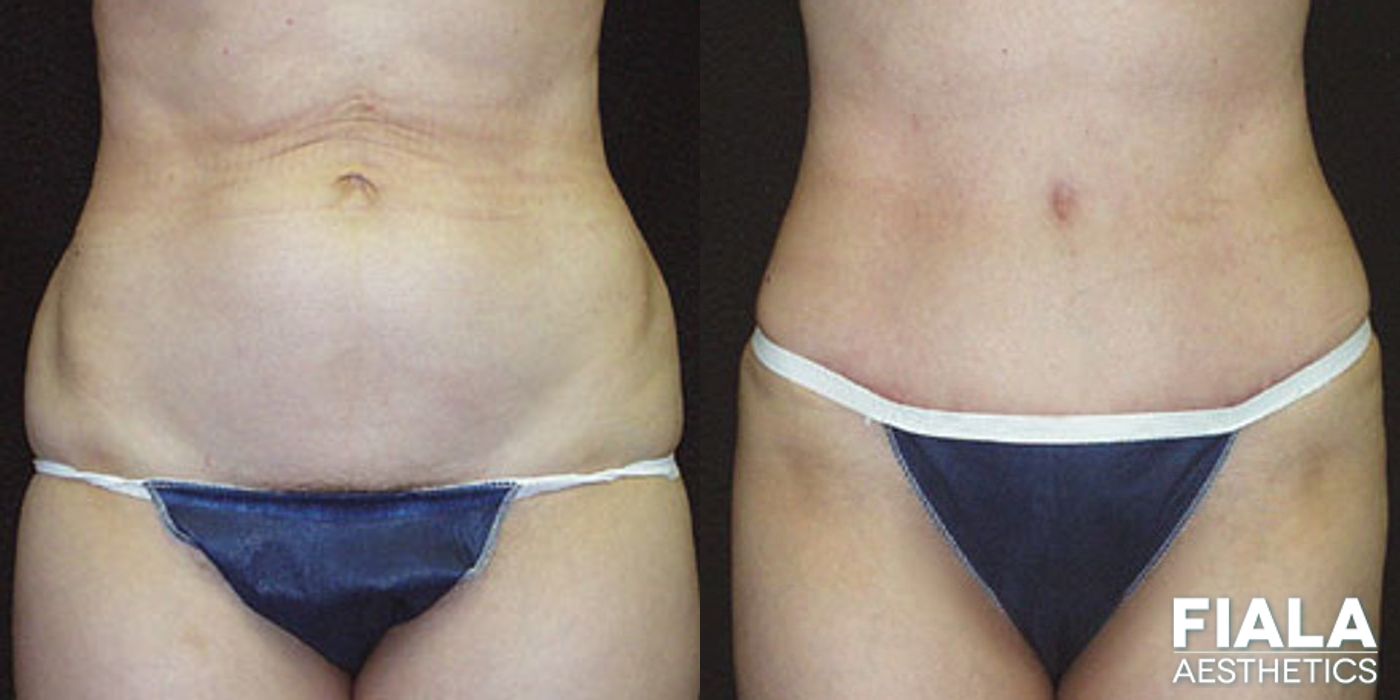 Before and after Tummy Tuck case 13829