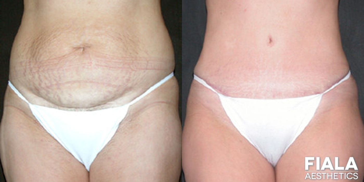 Tummy Tuck - Case 9082