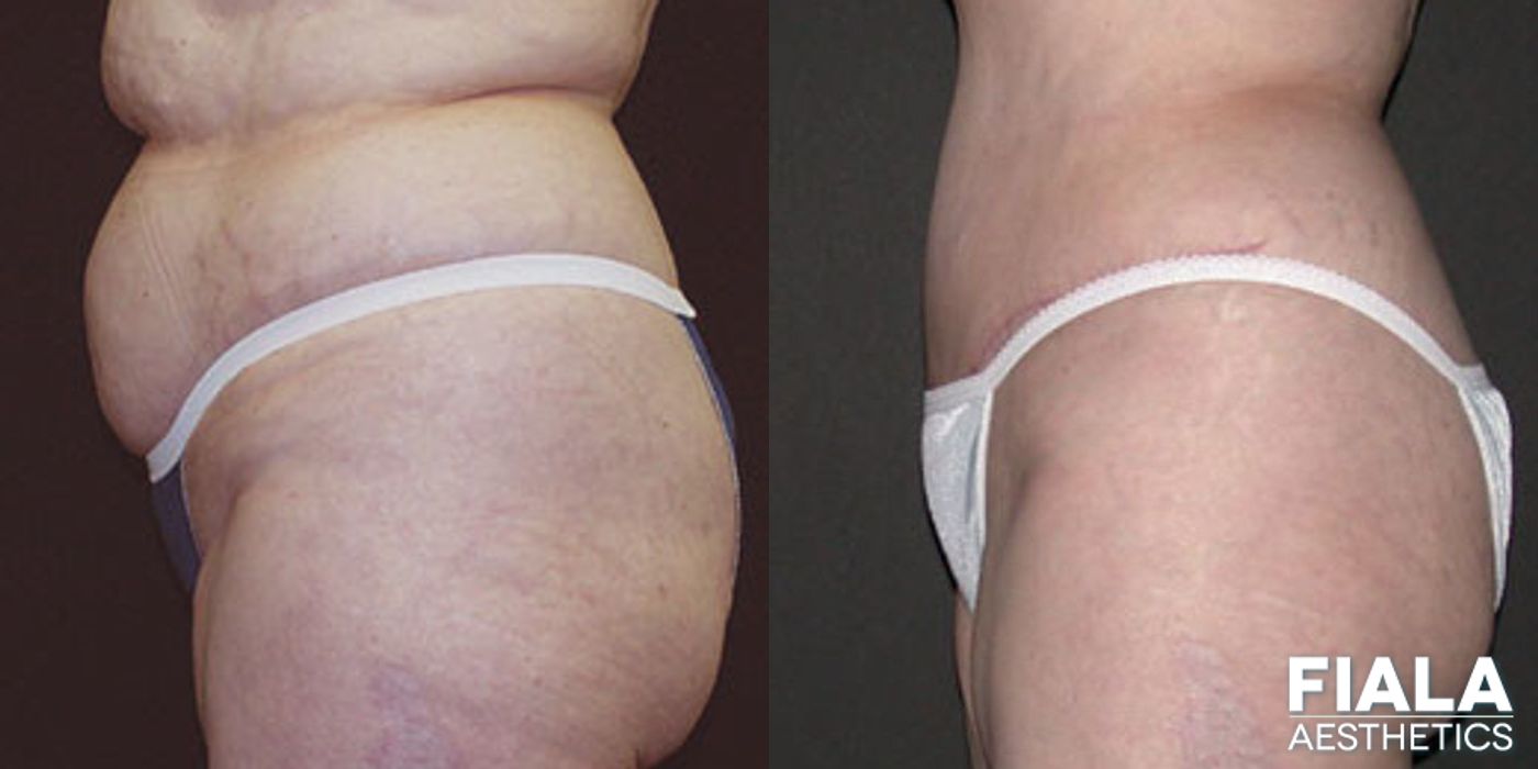 Extended tummy tuck with liposuction showing flatter abdomen and slimmer waistline two months after surgery by Dr. Fiala - Angle 2