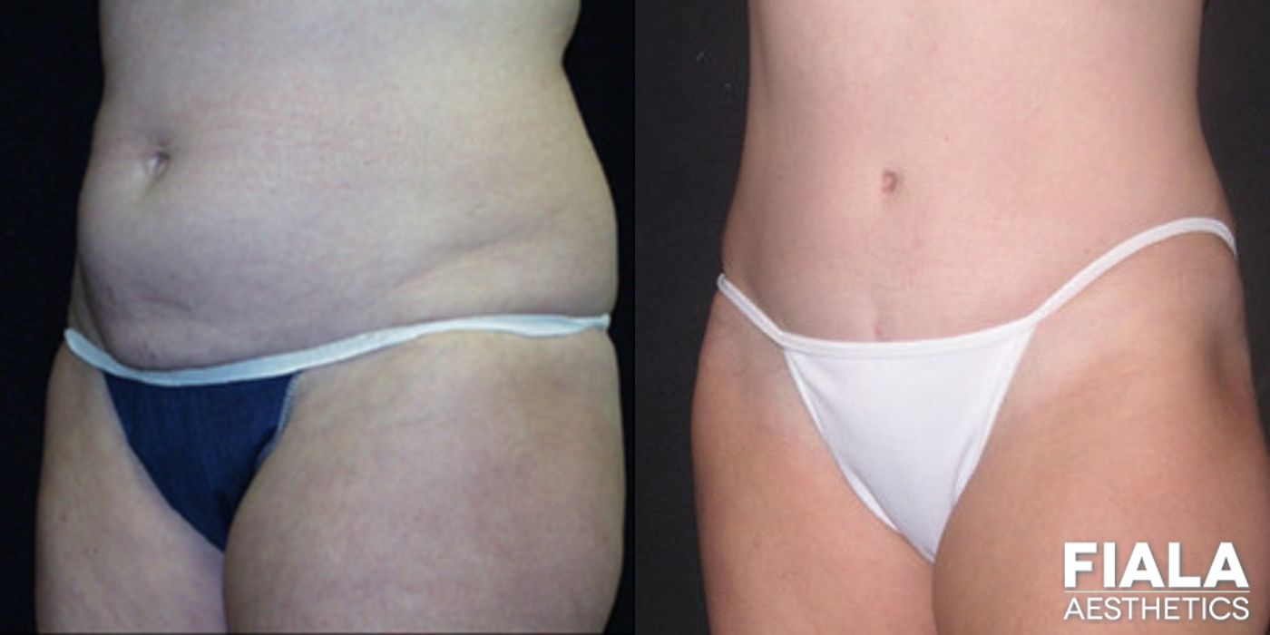 Before and after Tummy Tuck case 13814 - Angle 2