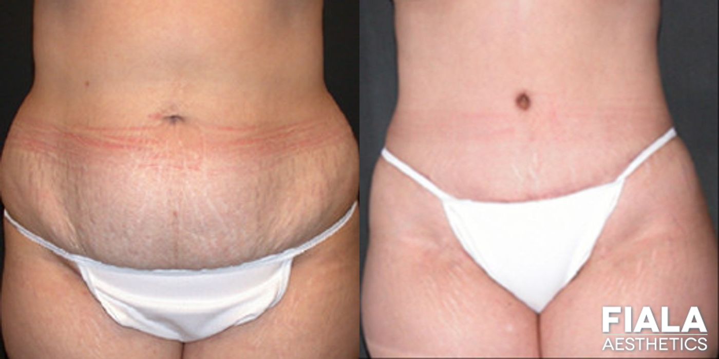 Extended tummy tuck and liposuction two months post-op showing improved midsection definition and natural-looking results by Dr. Fiala