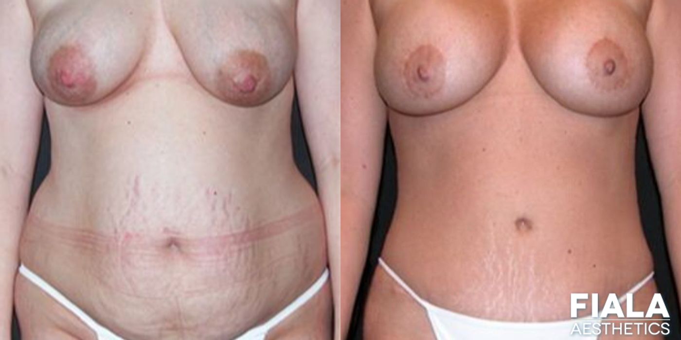 Breast Lift - Thumbnail 3