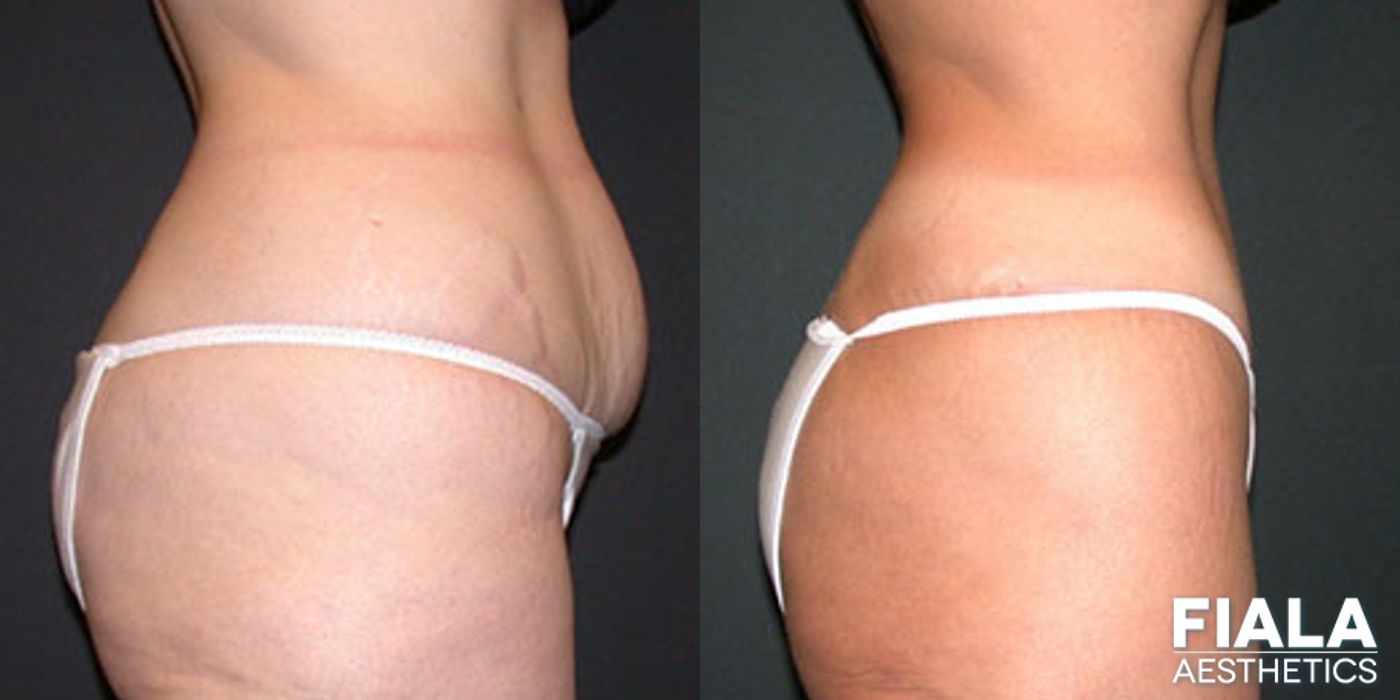 Before and after Tummy Tuck case 13818 - Angle 2