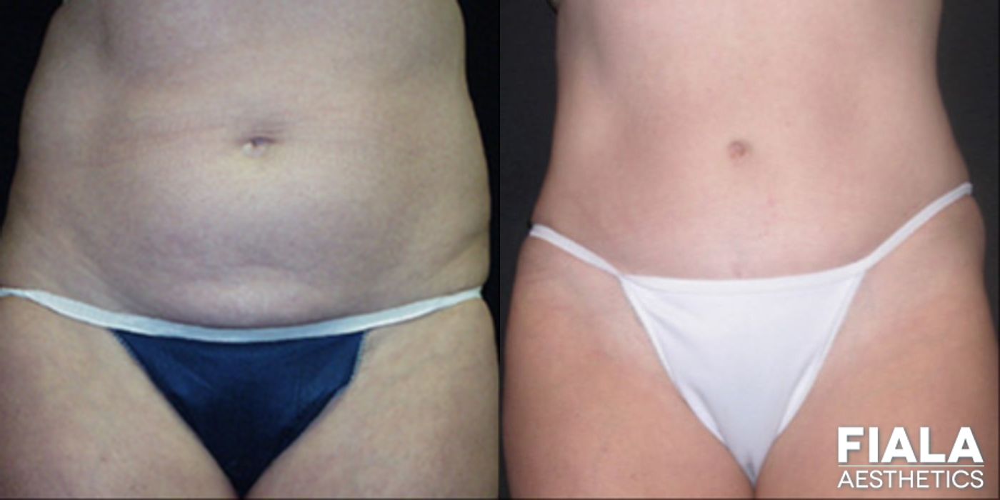 Before and after Tummy Tuck case 13814