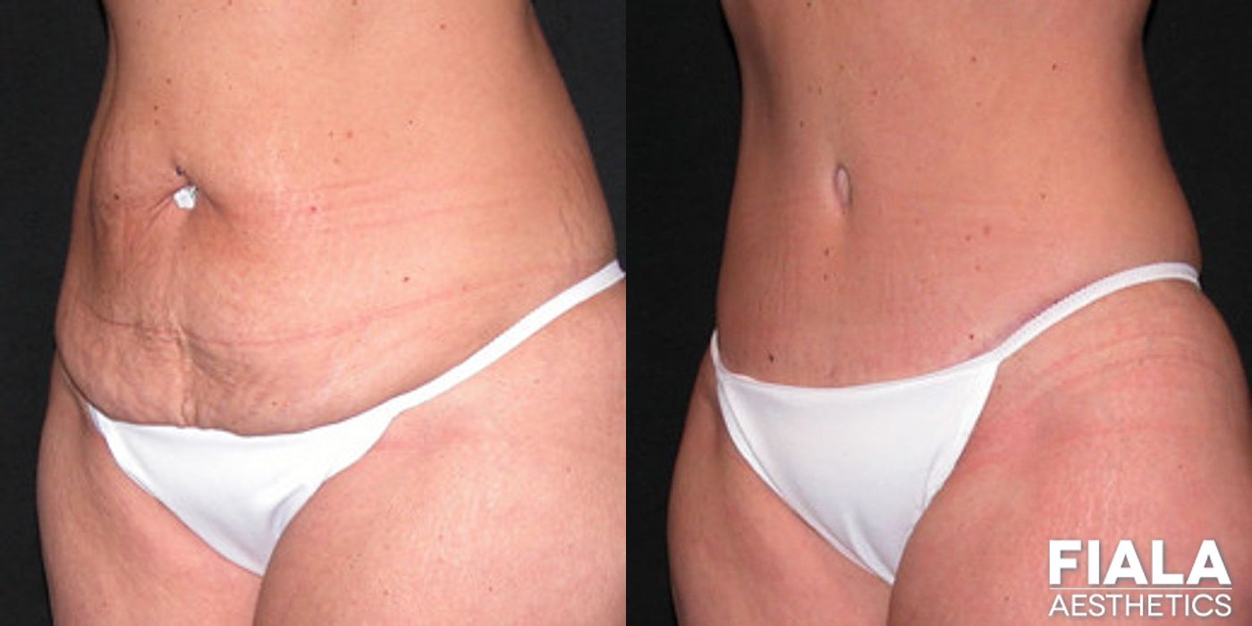 Before and after procedure result