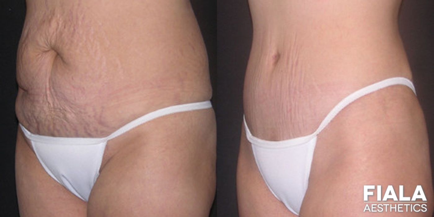 Before and after Tummy Tuck case 13823 - Angle 2
