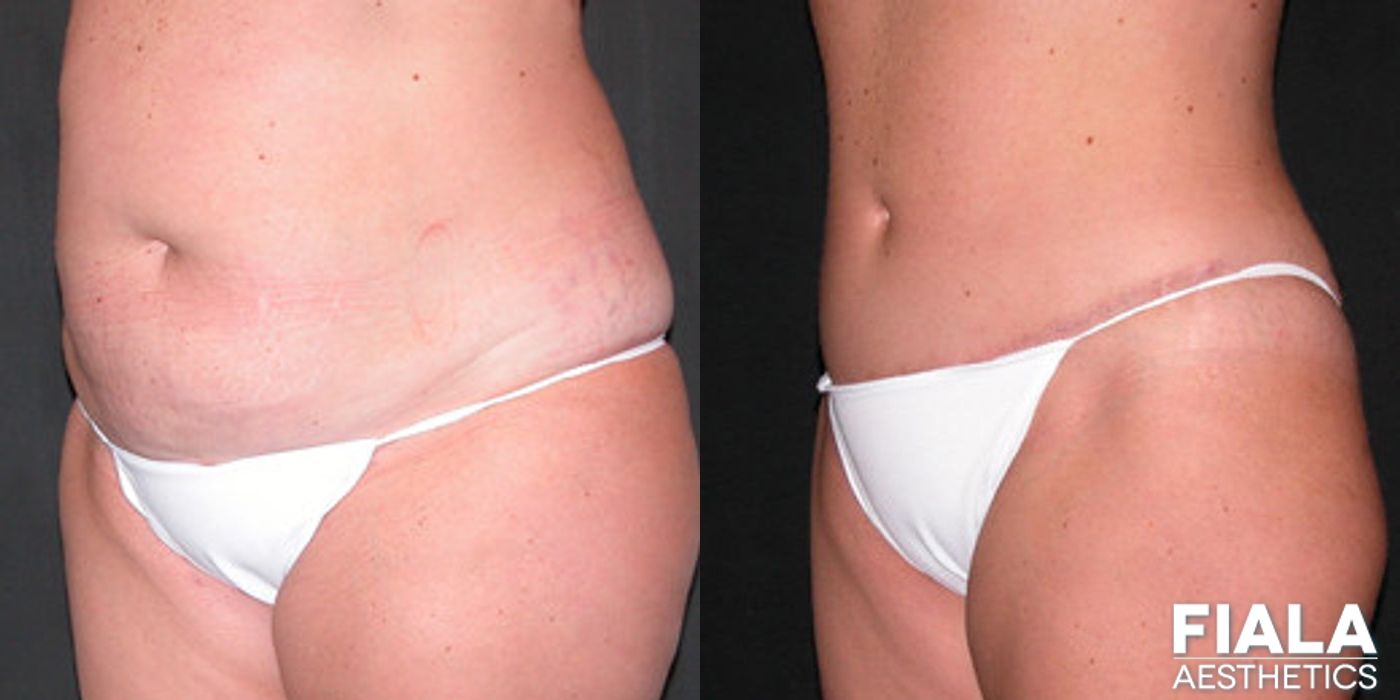 Tummy Tuck - Thumbnail 2