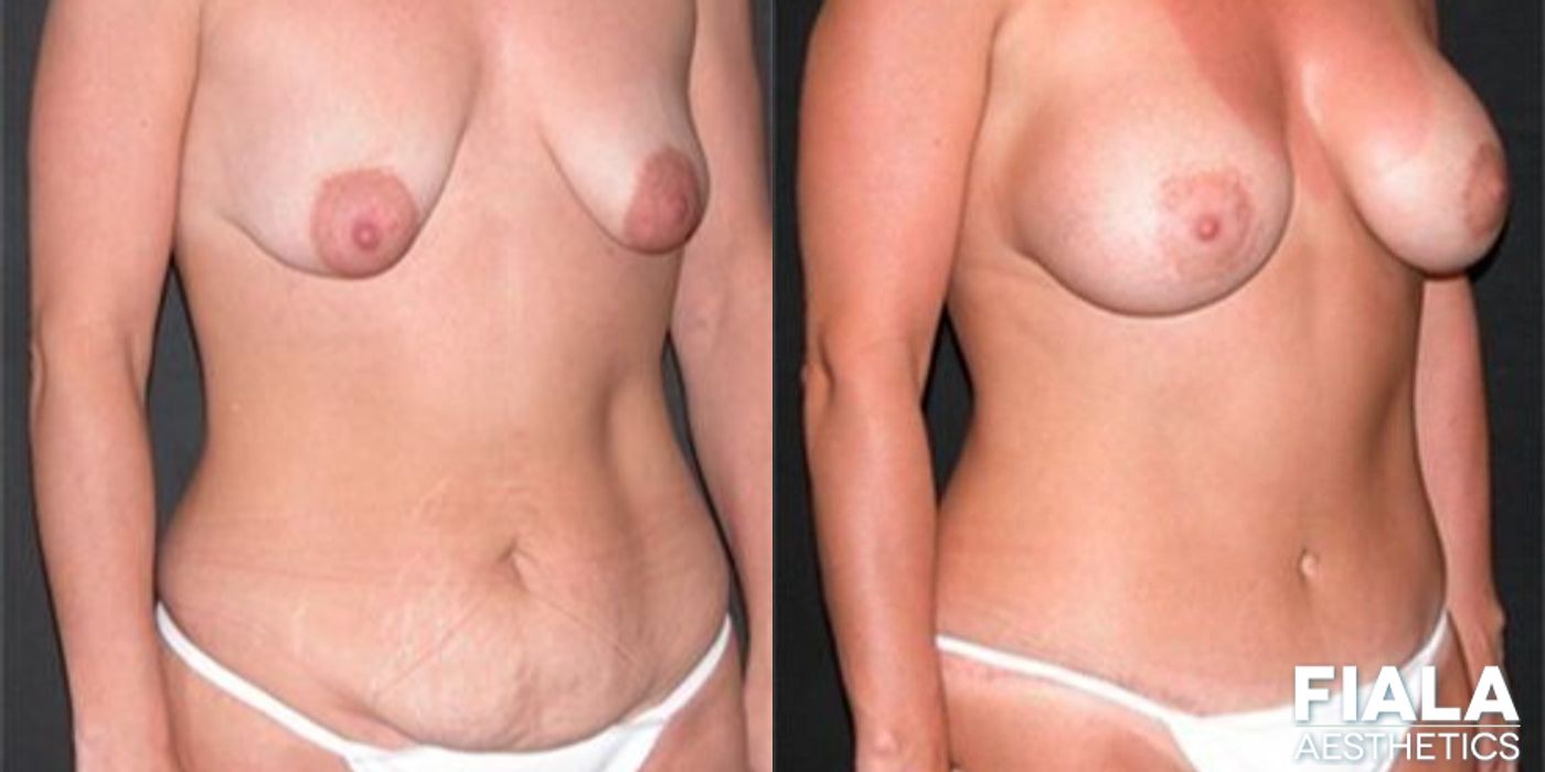 Breast Lift - Case 9185