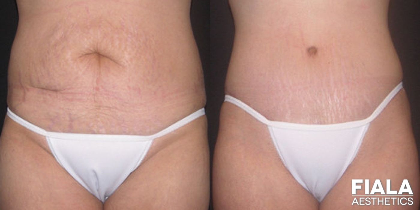 Before and after Tummy Tuck case 13823