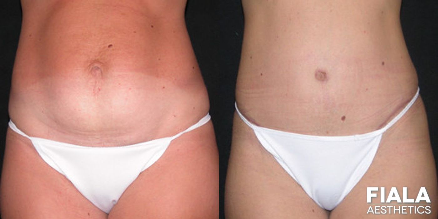 Before and after Tummy Tuck case 13820