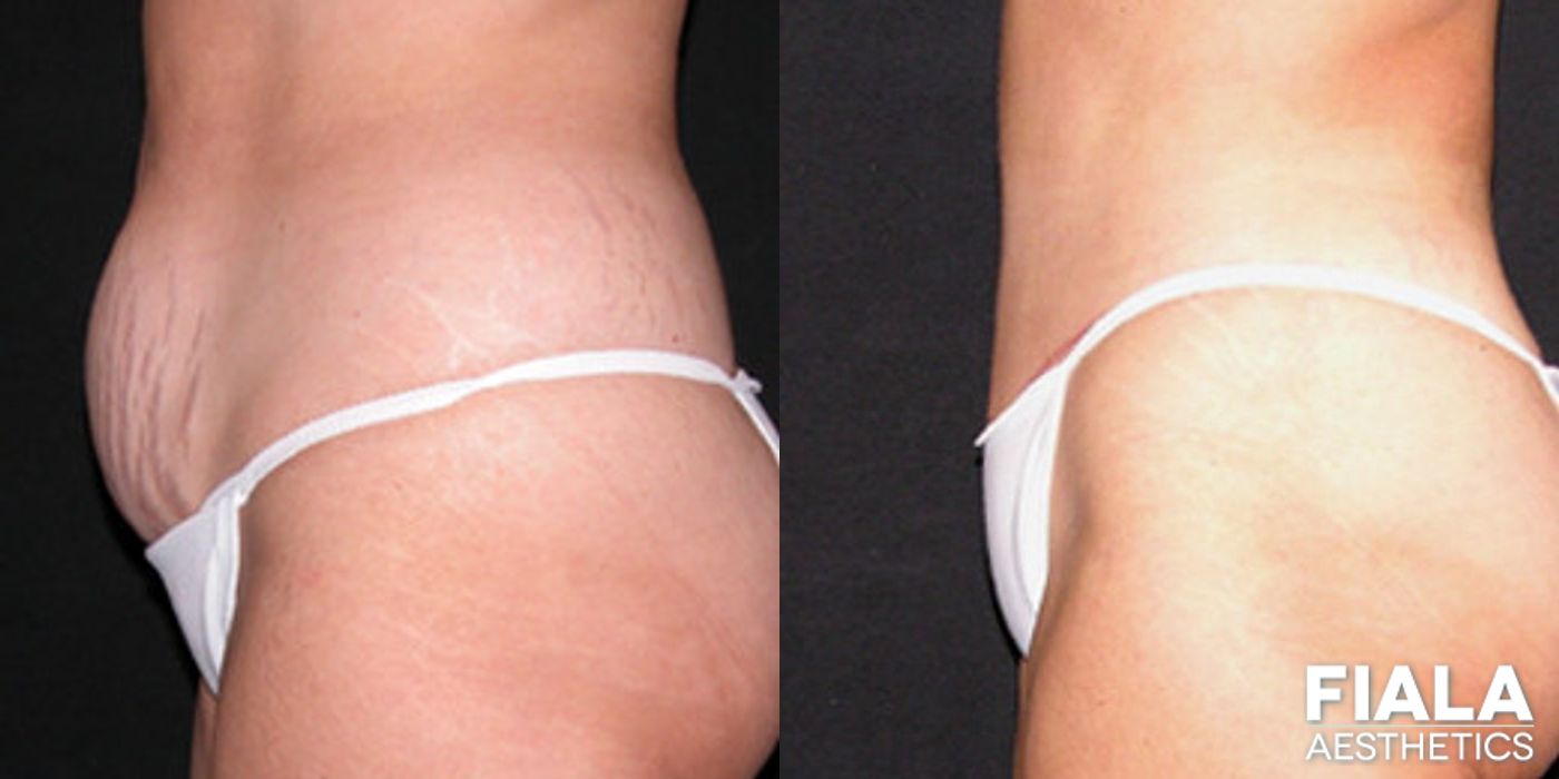 Before and after Tummy Tuck case 13821 - Angle 2