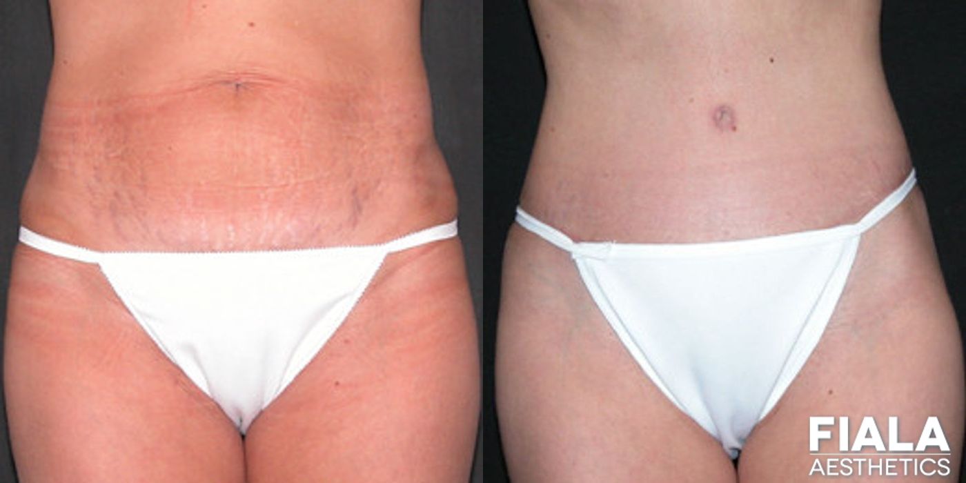 Tummy Tuck - Case 9088