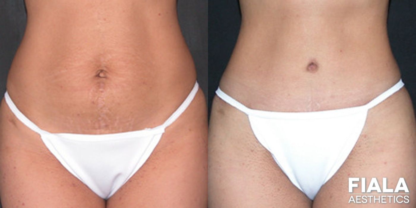 Before and after Tummy Tuck case 13830