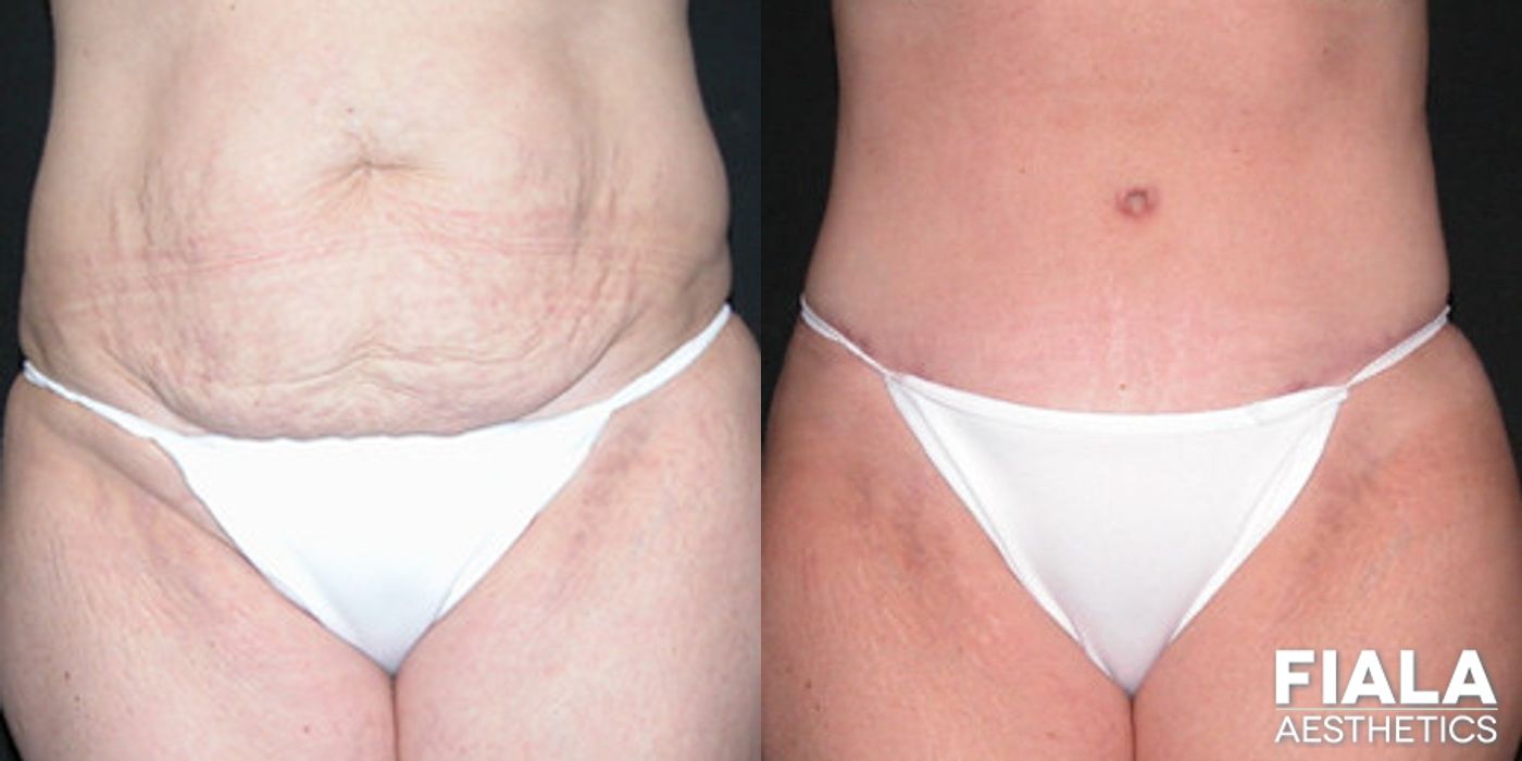 Before and after Tummy Tuck case 13835
