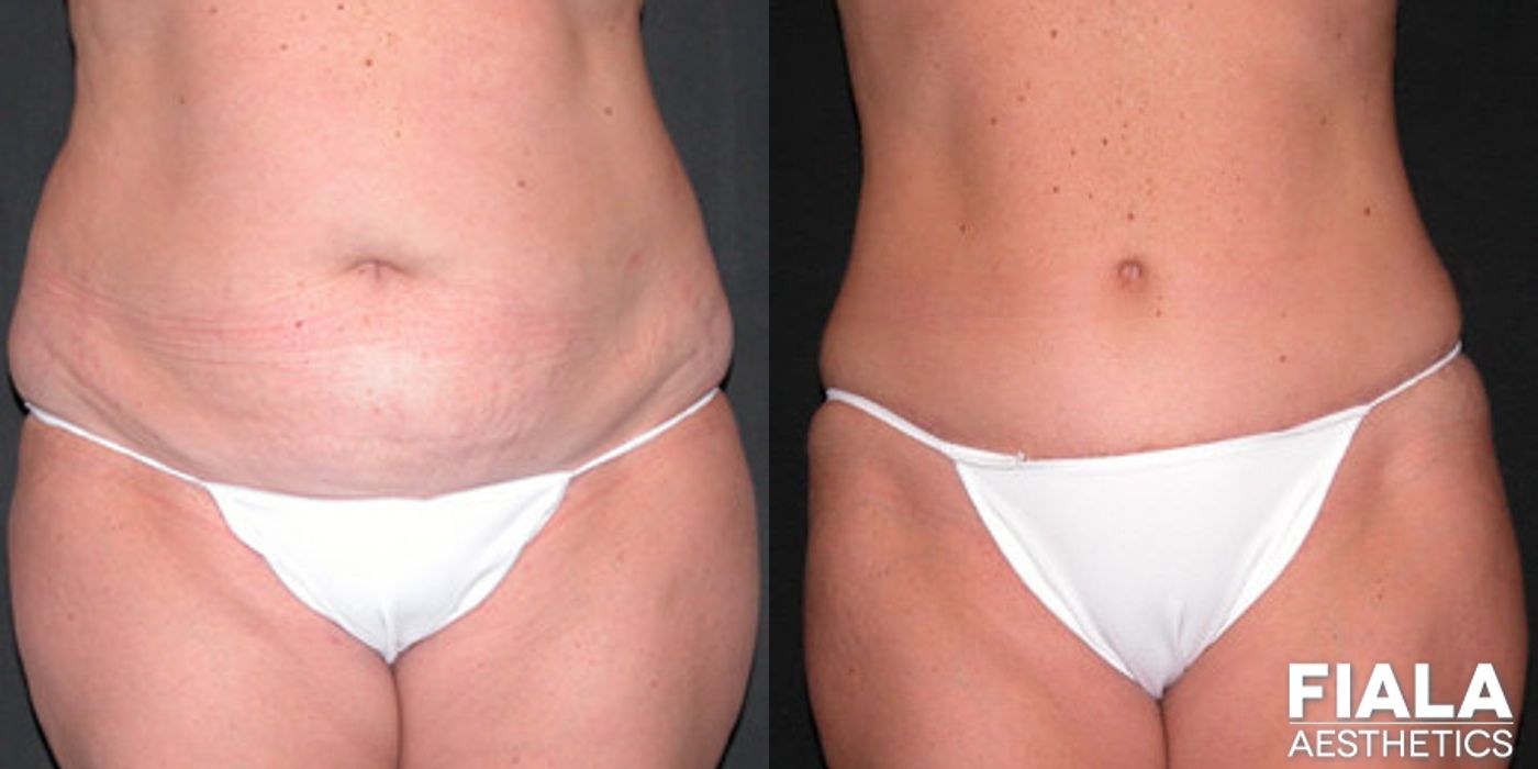 Tummy Tuck - Case 9090