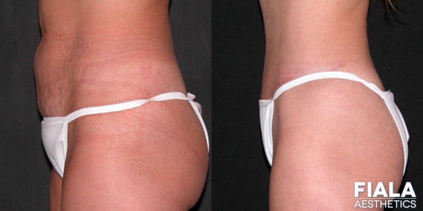 Tummy Tuck - Thumbnail 2