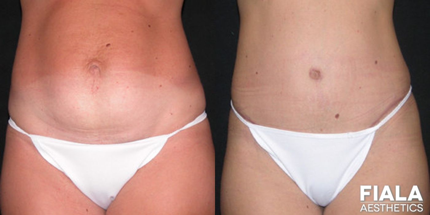 Tummy Tuck - Case 9076