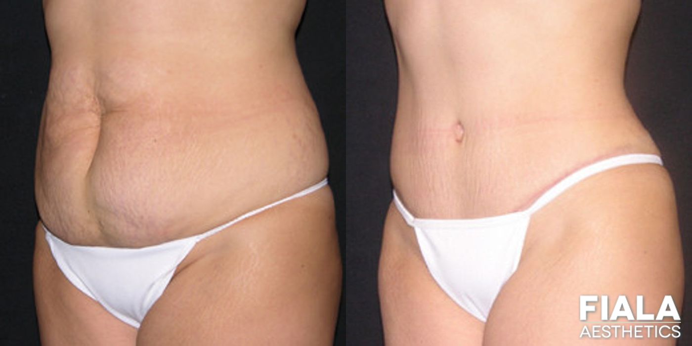 Before and after Tummy Tuck case 13831 - Angle 2