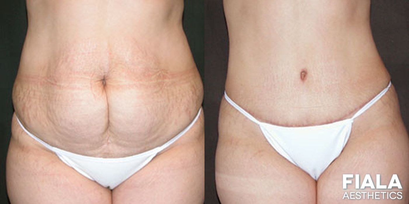 Before and after Tummy Tuck case 13842