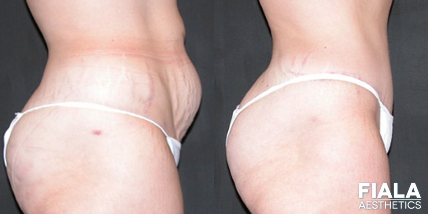 Before and after Tummy Tuck case 13827 - Angle 2