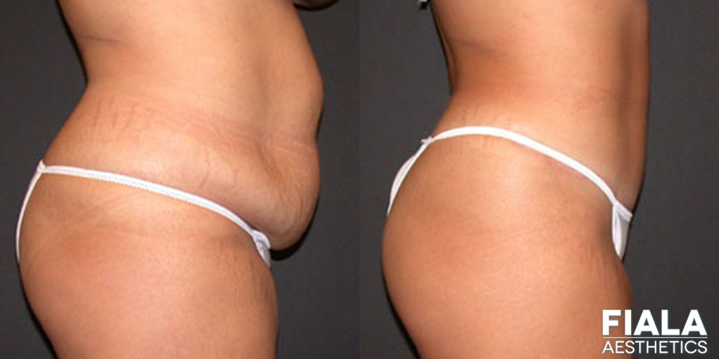 Tummy Tuck - Thumbnail 2