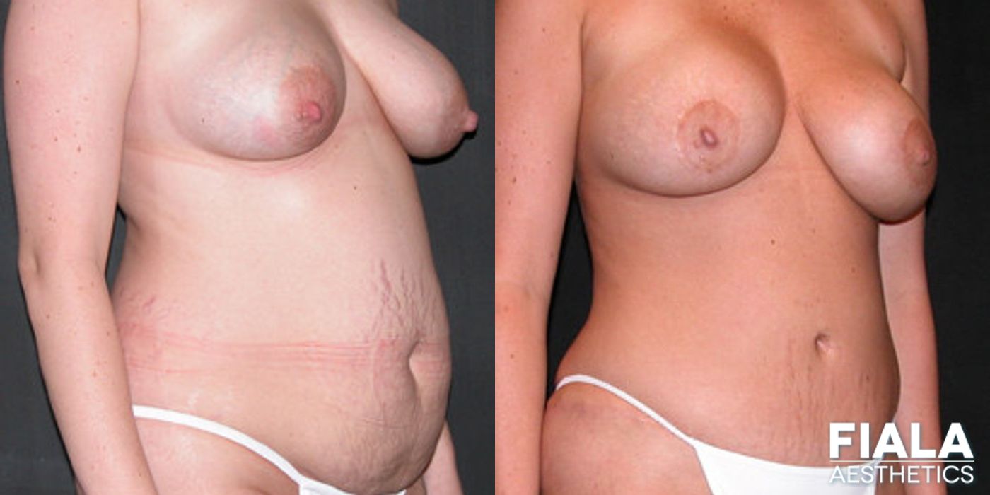 Before and after Tummy Tuck case 13841 - Angle 2