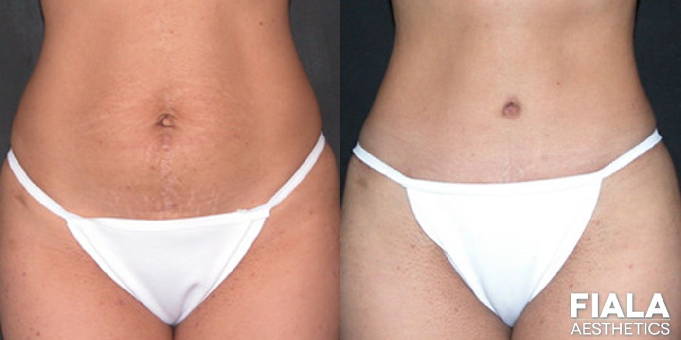Tummy Tuck - Case 9086