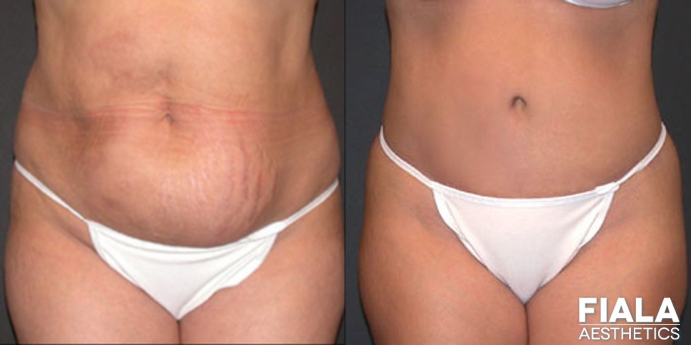 Tummy Tuck - Case 9084
