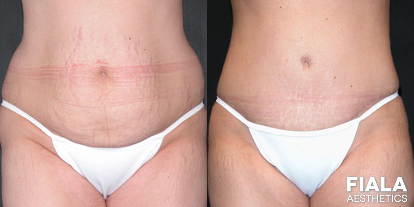 Before and after Tummy Tuck case 13824