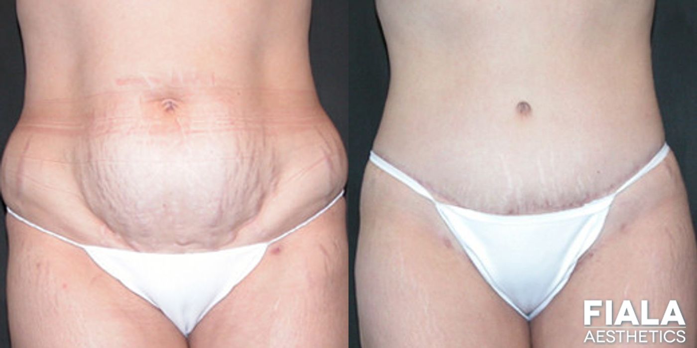 Tummy Tuck - Case 9083