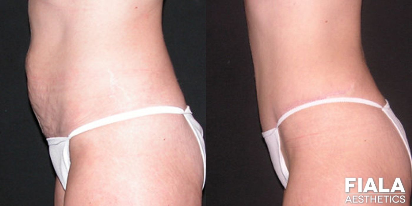 Tummy Tuck - Thumbnail 2