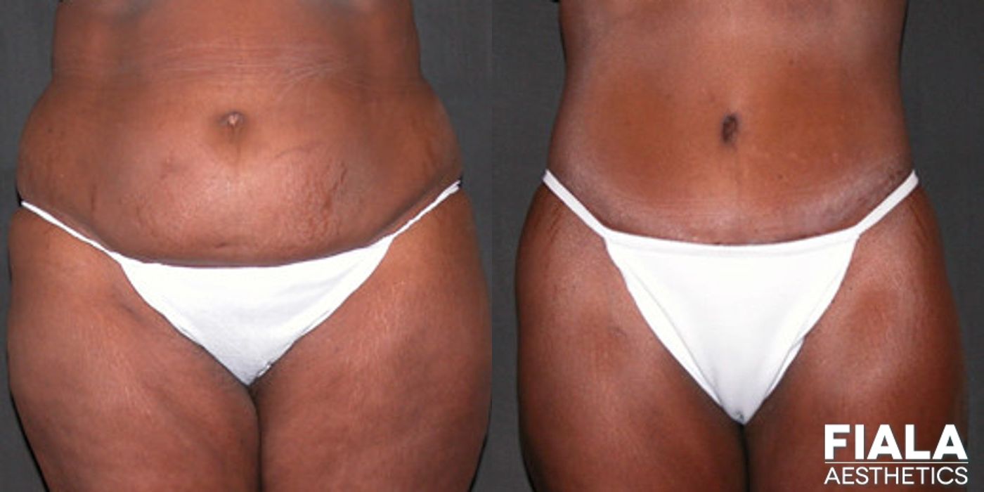 Before and after procedure result